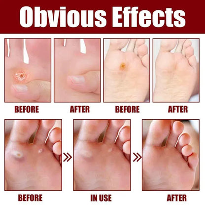 Feet Corn Removal Serum 30ml ( Pack Of 1 ) DS104465